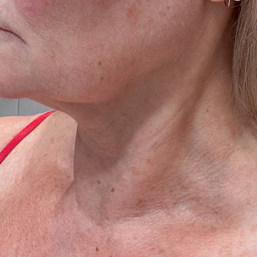 Close up After photo of woman's chin and neck having taken The Solution, Oslo Skin Lab's collagen powder. Her name is Helena