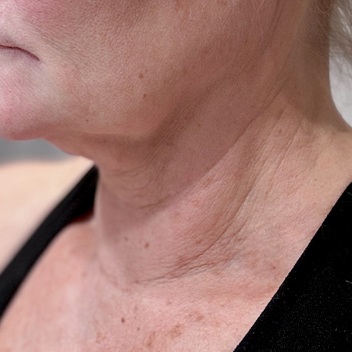 Close up Before photo of woman's chin and neck having taken The Solution, Oslo Skin Lab's collagen powder. Her name is Helena