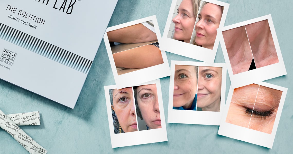 Before and after images of women taking The Solution collagen