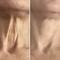 Before & After neck